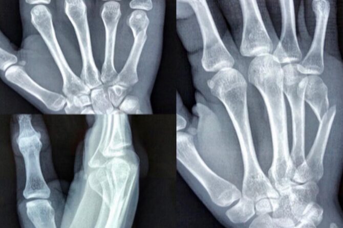 Fracturas del cuello metacarpiano – SECMA Academy